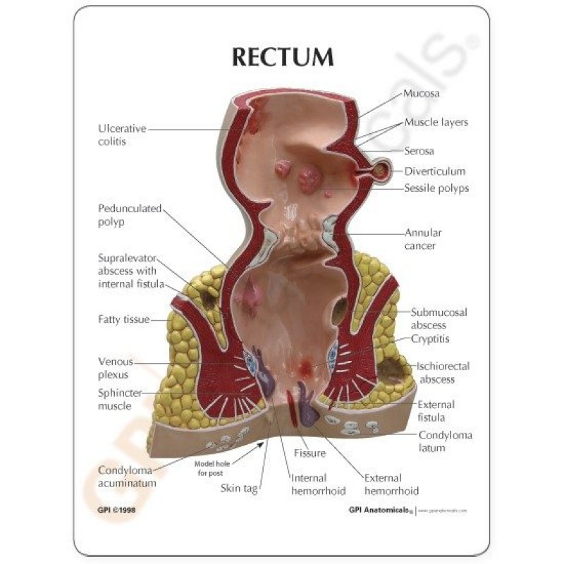 endeldarm-rectum-model-met-infokaart